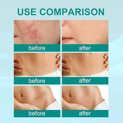 South Moon Scar Spray 20g medical grade skin care spray for scar appearance treatment and skin regeneration care — image 4